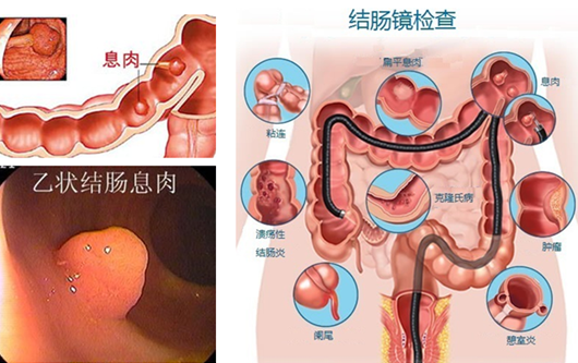 南寧直腸炎治療費用要多少錢